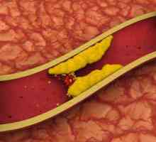 Visok nivo holesterola - opasnost za život