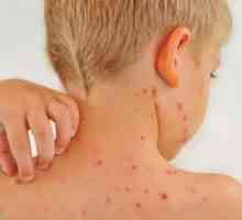 Osip na koži u obliku crvene mrlje: uzroci