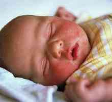 Škrofula bebu: uzroci, simptomi, liječenje