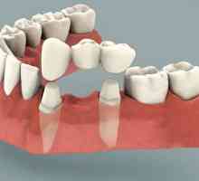 Zubni most: recenzije. Instalacija zubni most