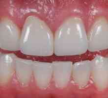 Keramičkih zuba: pregled, karakteristike i proizvodnja recenzije