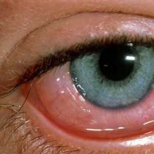 Alergijskog konjunktivitisa: karakteristike, naravno i liječenje