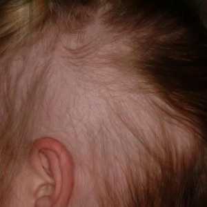 Alopecija kod djece: Uzroci i liječenje. Alopecija, a ukupna alopecija kod djece