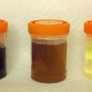 Urina analiza: vrste i metode prikupljanja