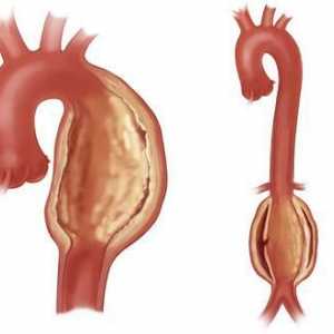 Aneurizma aorte srca - što je to? Aorte aneurizme: uzroci, simptomi, tretman