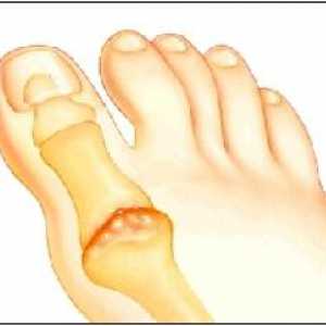 Artritisa stopala: vrsta, prevencija