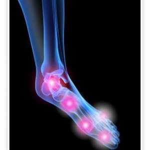 Artritisa stopala zajedničkog: uzroci, simptomi i liječenje