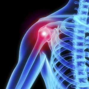 Osteoartritisa ramenog zgloba: Simptomi i tretman narodnih pravnih lijekova, uzrocima i metodama…