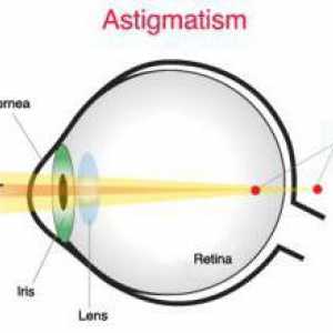 Astigmatic kontaktne leće: funkcija, vrste i upotreba tehnologije