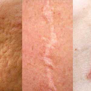 Atrofični ožiljci: uzroci tretmana