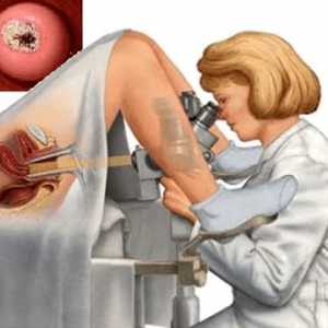 Biopsija grlića: šta je to i zašto se taj postupak obavlja?