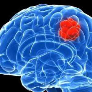 Cerebralna blastoma: simptomi, prognoza