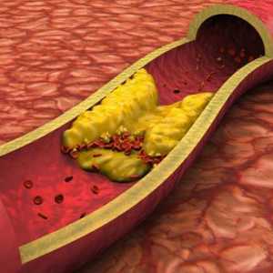 Plakete u karotidnu arteriju: tretman. Holesterol plakete: uzroci, simptomi