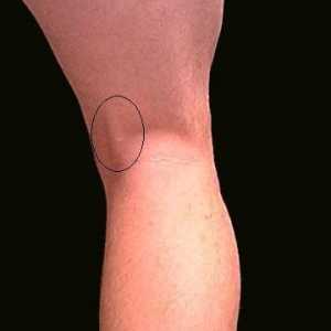 Bol iza koljena s leđa - Uzroci
