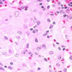 Gaucher bolesti - nasljedni poremećaj metabolizma lipida