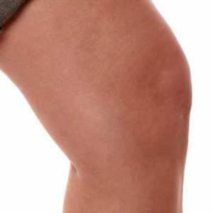 Ono što karakteriše tretman sinovitis koljena?