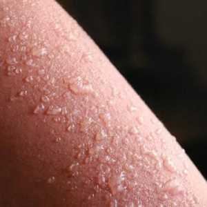 Šta izaziva osip na koži u obliku mjehurića?