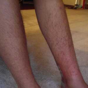 Svrbi osip na nogama: Uzroci, prevencija