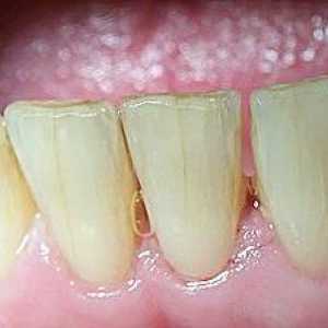 Šta ako je bilo pukotine u zubima? Uzroci i tretman