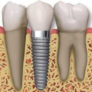 Da stomatolozi preporučuju, kada postoji potreba da ubacite zube?