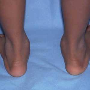 Ono što je ploskovalgusnye stopala kod djece i kako ih liječiti