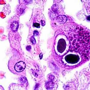 Citomegalovirus infekcija: simptomi kod žena. Uzroci i tretmani za CMV infekcije