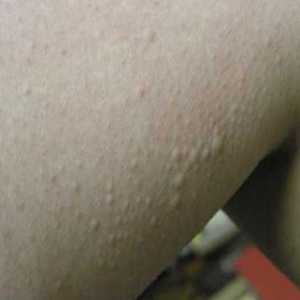 Bubuljice na rukama: tretman zime alergije