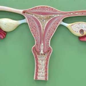 Dijagnozu "endometrioze": simptomi i liječenje bolesti