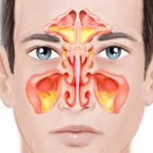 Dvostrano sinusitis: simptomi i liječenje