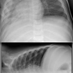 Bilateralni pneumonija: kako se manifestuje, gdje i kako ga liječiti