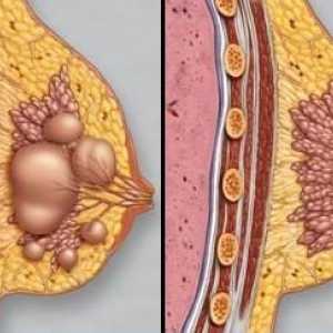 Dojke fibroze: dijagnostici i liječenju