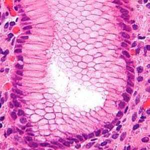 Gastritis sa kiselosti: liječenje i prevencija