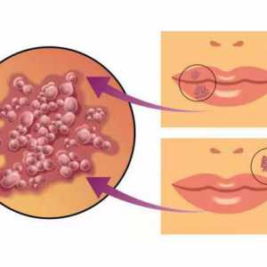 Herpes na usnama u djece: karakteristike i uzroci