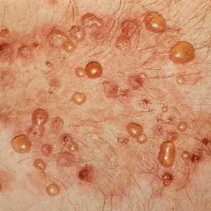 Dermatitis herpetiformis: Uzroci, Simptomi i metode tretiranja