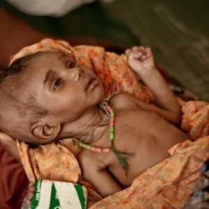 Neuhranjenosti kod djece i simptome