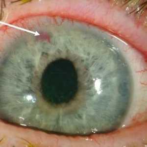 Glaukom - Simptomi i metode tretiranja