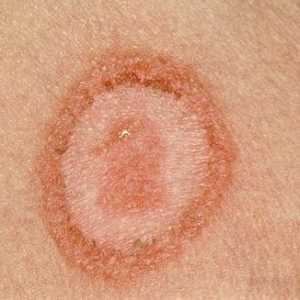 Gljivične bolesti kože je lakše spriječiti nego cure