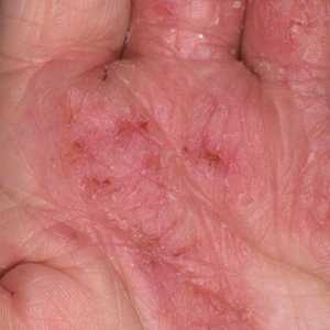 Gljiva pri ruci: uzroci, simptomi i tretman