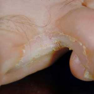 Gljivica stopala, simptom i tretman metode