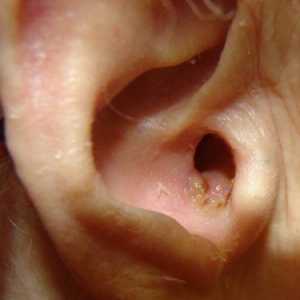 Gljivice u uhu: šta da radim?