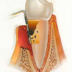 Hronične i akutne parodontitis: simptomi, uzroci i liječenje