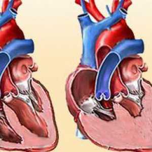 CHF: klasifikacije. Simptomi liječenje hroničnog zatajenja srca