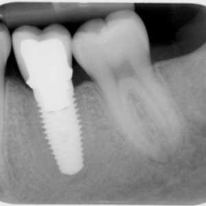 Dentalnih implantata: kontraindikacije i moguće komplikacije (recenzija)