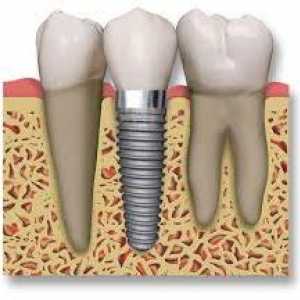 Dentalni implantati: recenzije operacije pacijent
