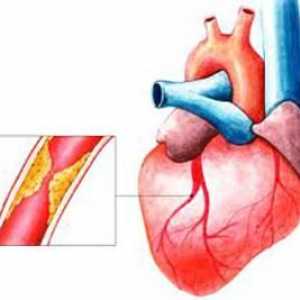 Srčani udar - jedan od najčešćih ljudskih bolesti