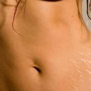 Informacije za žene: kako ukloniti strije na stomaku
