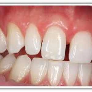 Malokluzije kod odraslih. Zdravi zubi - beautiful zuba