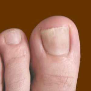 Efikasan tretman gljivičnih nokte narodne lekove