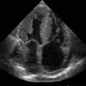 Echocardiography srce: karakteristike ovog istraživanja i indikacije za svoje ponašanje