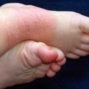 Ekcem na nogama: Simptomi i tretman